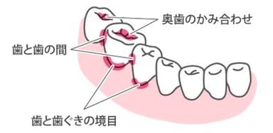 歯垢がつきやすいところ