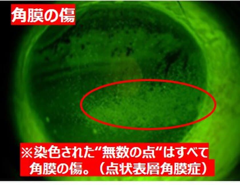 コロナ禍の花粉症シーズン本格化！“目こすり”に要注意
　角膜が傷つく＆手指消毒液が目に入るリスク