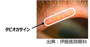 図10) タピオカサイン