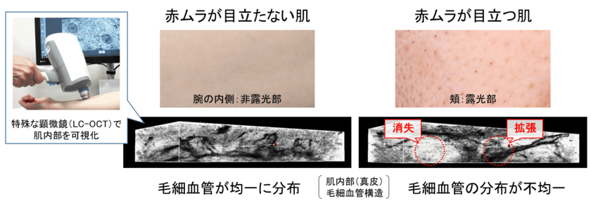 肌の内部構造を可視化し、色ムラが生じるメカニズムを解明　
紫外線による局所的な毛細血管の消失と拡張が
赤色のムラを生じさせる