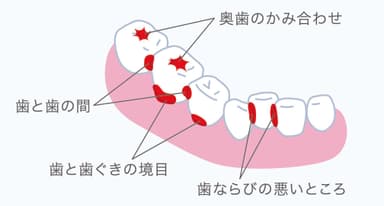 歯垢が残りやすい部分