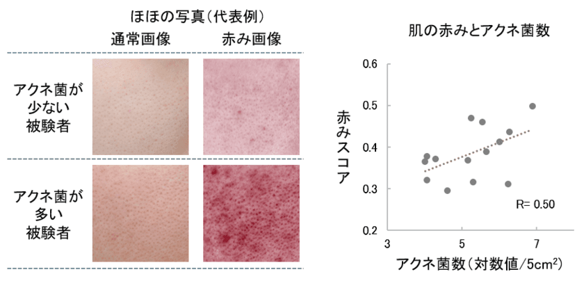 アクネ菌が肌の赤みに関与することを発見