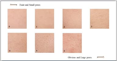 図1　毛穴グレードの評価基準※　※Kim&#44; S. J.&#44; et al. "Pore volume is most highly correlated with the visual assessment of skin pores. " Skin Research and Technology 20.4 (2014): 429-434.