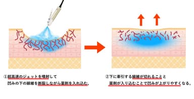 キュアジェットの仕組み