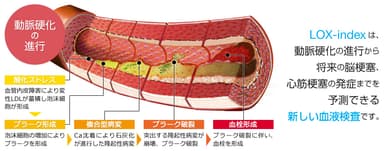 動脈硬化とLOX-index(R)