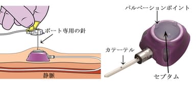 薬剤の注入イメージ図とポートの構造