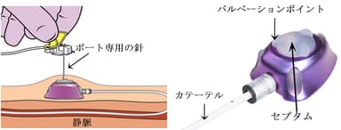 薬剤の注入イメージ図とポートの構造