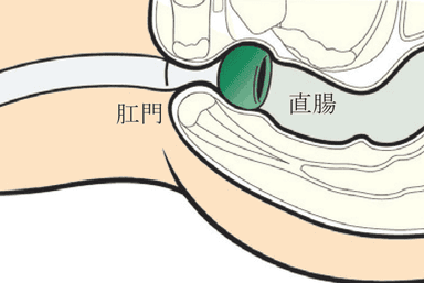 本品を直腸に挿入した模式図