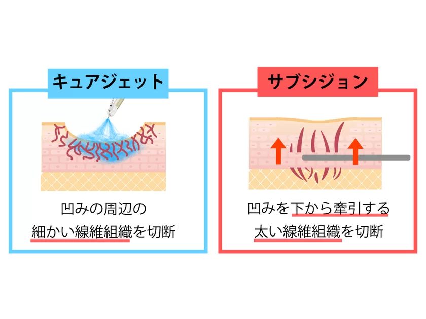 サブシジョンとキュアジェットによるマイクロサブシジョン